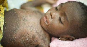 Kasaï Central : La Rougeole endeuille le secteur de Lubi
